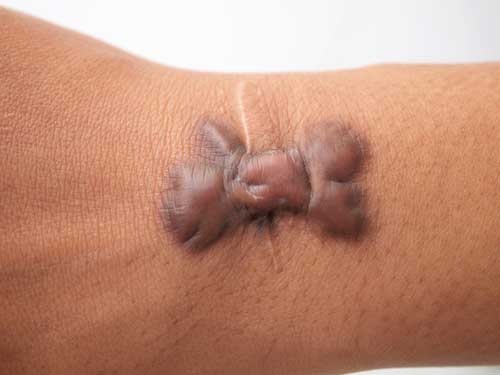 keloid litteken dat buiten de wond groeit en donker verdikt is