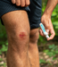 WUNDE 100 % natürliches Spray für akute und chronische Wunden