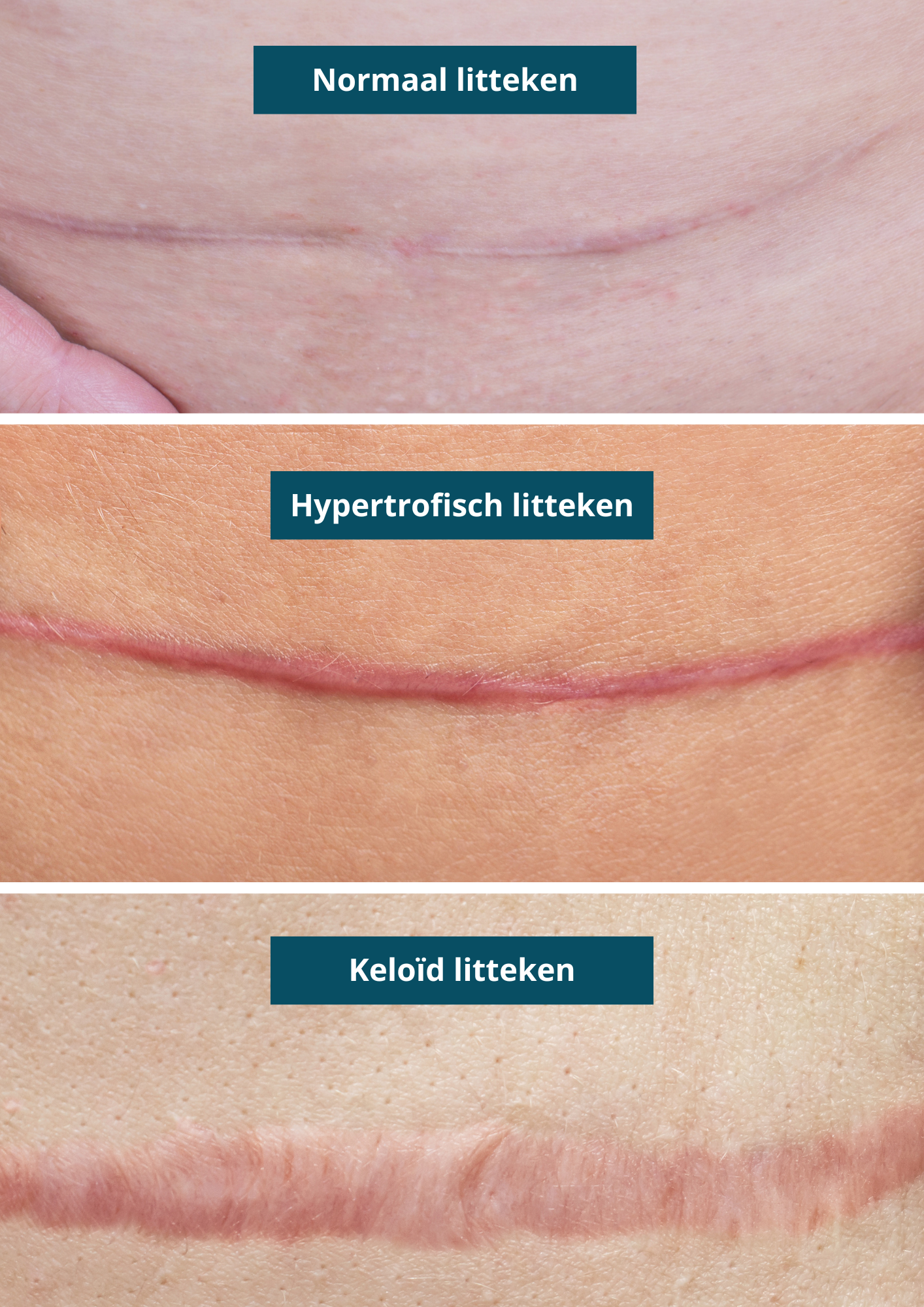 soorten littekens, hypertrofisch litteken en keloid litteken