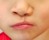 Litteken op de lip behandelen (tips bij herstel en nazorg)