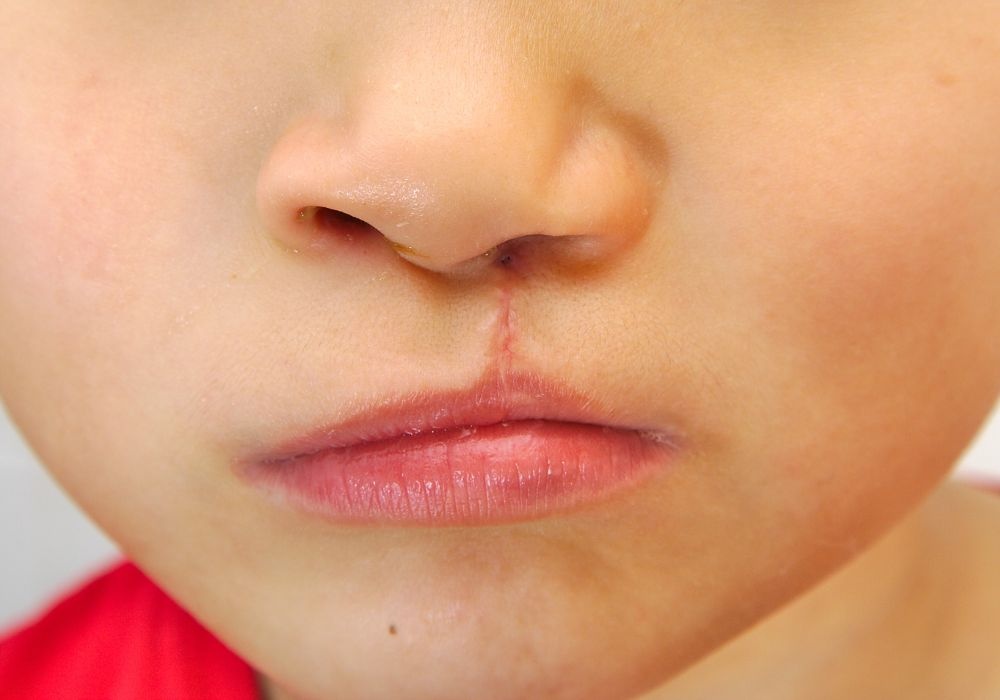 Litteken op de lip behandelen (tips bij herstel en nazorg)