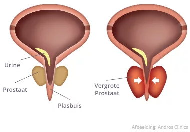 Infographic over hoe prostaatproblemen plasklachten veroorzaken
