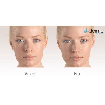 U-Derma