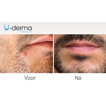 U-Derma