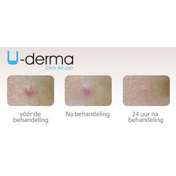 U-Derma