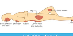 Bedsores