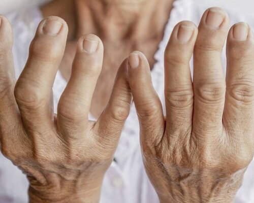 Living with Rheumatism: Understanding, Overcoming and Living Hopefully