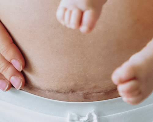 Douchen met hechtingen: Tips en Risico's