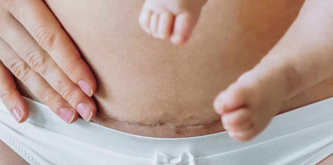 Douchen met hechtingen: Tips en Risico's