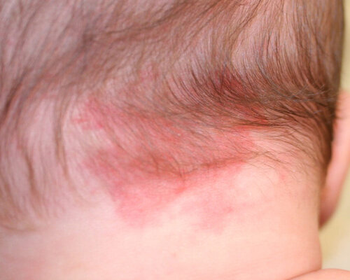 Wat is een 'ooievaarsbeet' of 'engelenkus'?