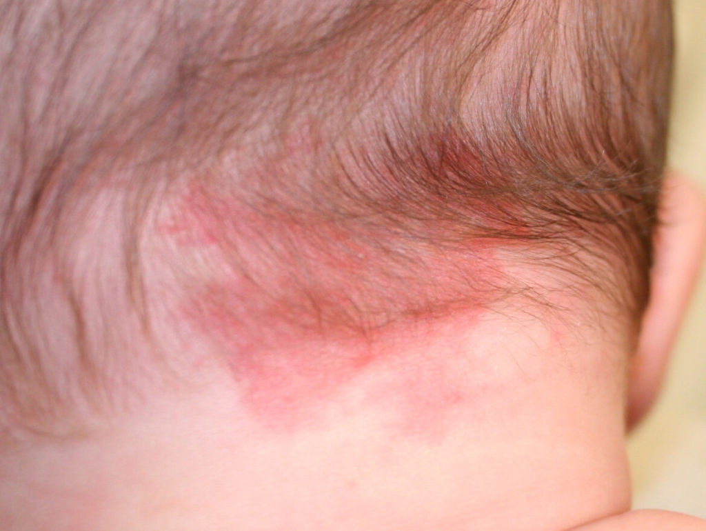 Wat is een 'ooievaarsbeet' of 'engelenkus'?