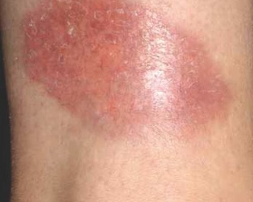 Diabetische dermopathie: Wat zijn suikerplekken?