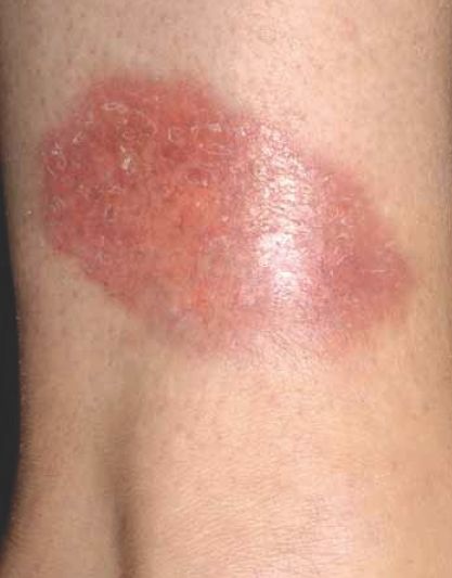 Diabetische dermopathie: Wat zijn suikerplekken?