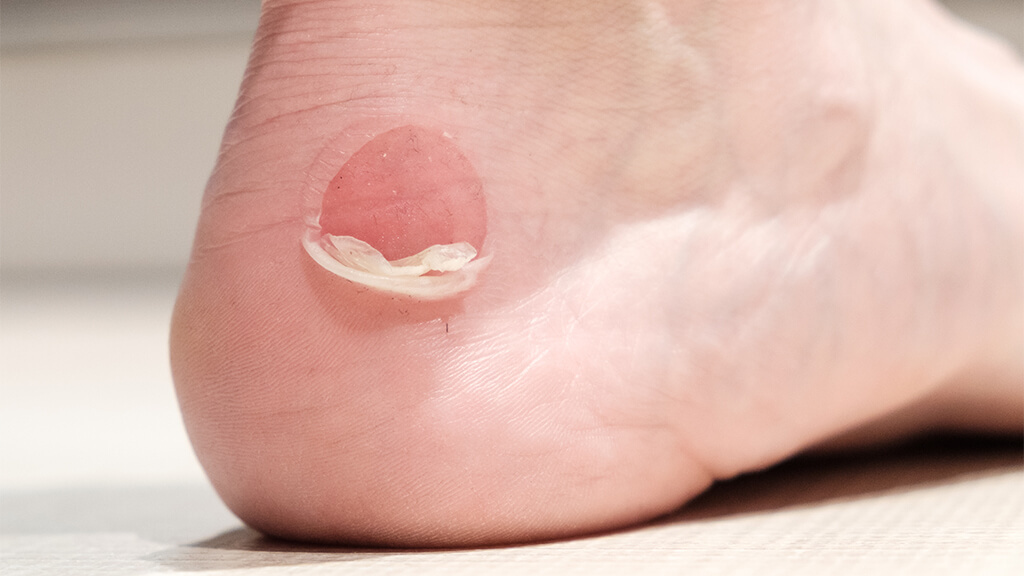 Een blaar verzorgen: Openprikken of niet?