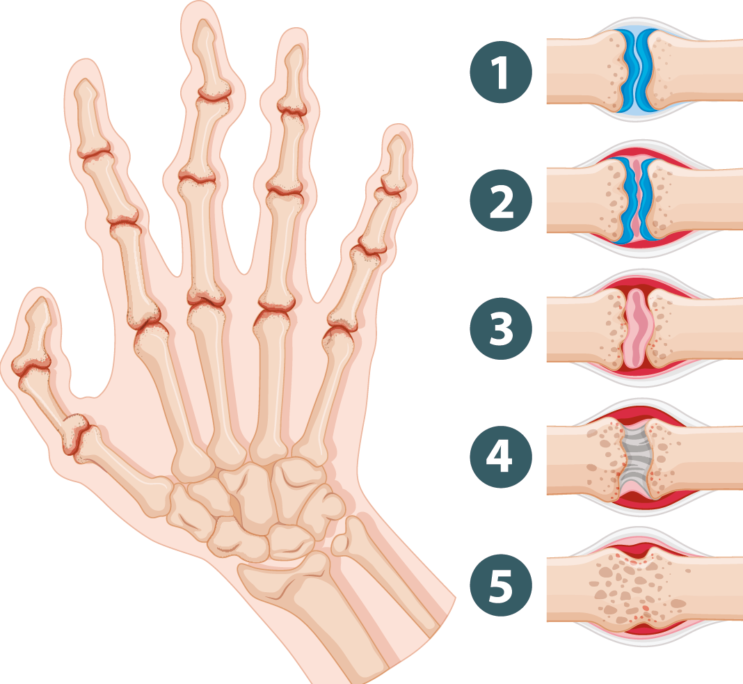Meer pijn als het koud en nat is: heeft het weer invloed op reuma?