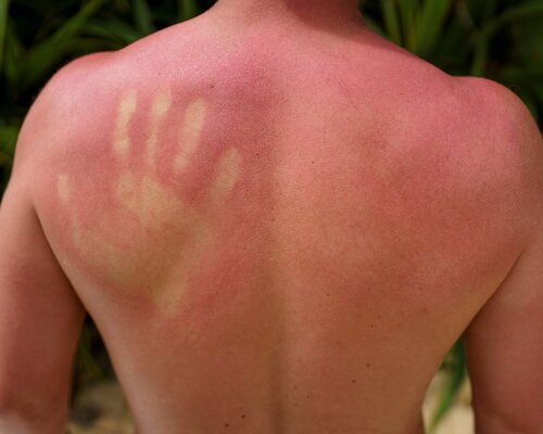 Zonneslag, Zonnebrand, Diarree: Effectieve Tips tegen Zomerkwaaltjes