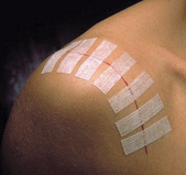 3M Steri-Strip adhesive strips