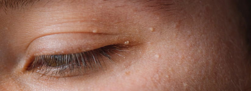 Milia behandeling met naalden