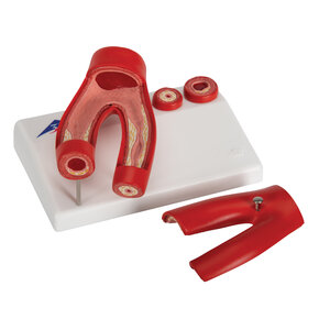 3B Arteriosclerosemodel, met doorsnede van een slagader, 2-delig