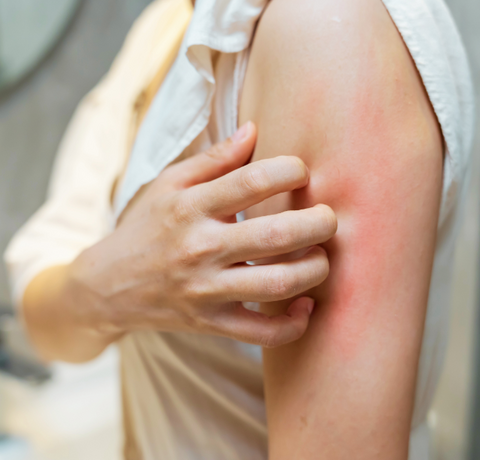 Skin allergy: what is it, how do you recognize it, and how do you choose products that are safe?