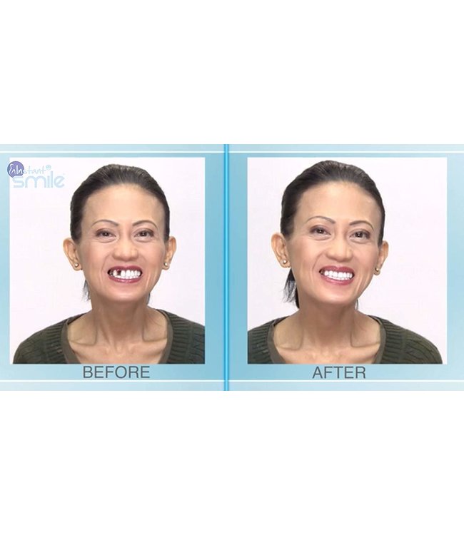 GrillzShop Tand afgebroken reparatie kit InstantSmile gebit (goedkope kunstgebit) - Theeth Recovery -  Multishade