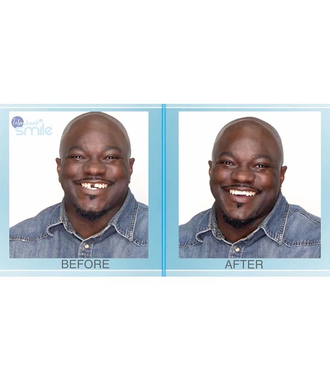 GrillzShop Tand afgebroken reparatie kit InstantSmile gebit (goedkope kunstgebit) - Theeth Recovery -  Multishade