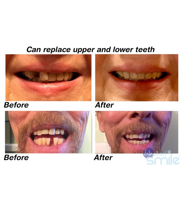 GrillzShop Tand afgebroken reparatie kit InstantSmile gebit (goedkope kunstgebit) - Theeth Recovery -  Multishade