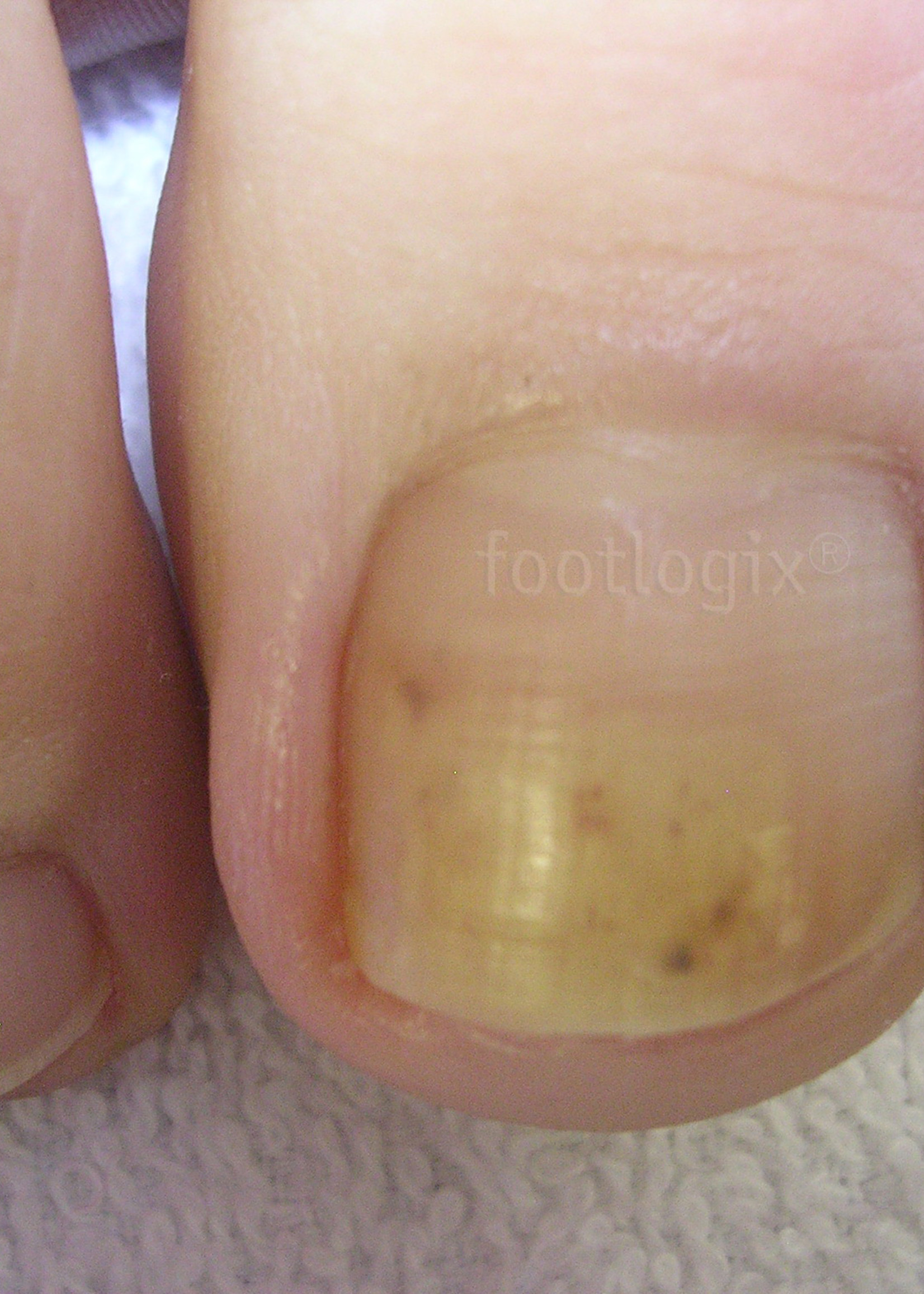 Footlogix Toe Nail Tincture 50 ml