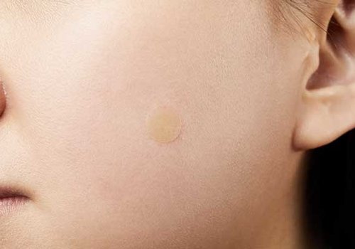 Spot Treatments