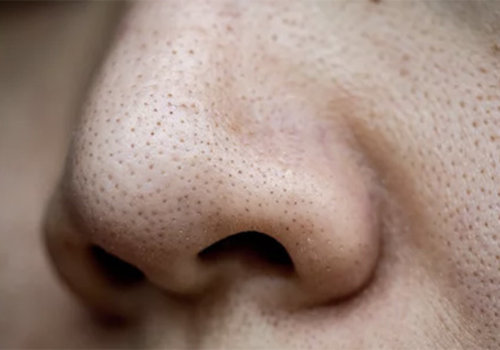 Blackheads Blackheads