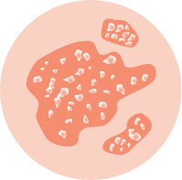 Eczema