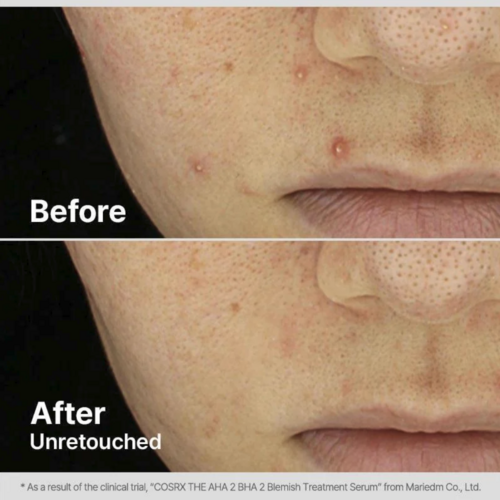COSRX The AHA 2 BHA 2 Blemish Treatment Serum COSRX The AHA 2 BHA 2 Blemish Treatment Serum
