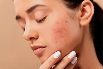Oplossingen voor hormonale acne