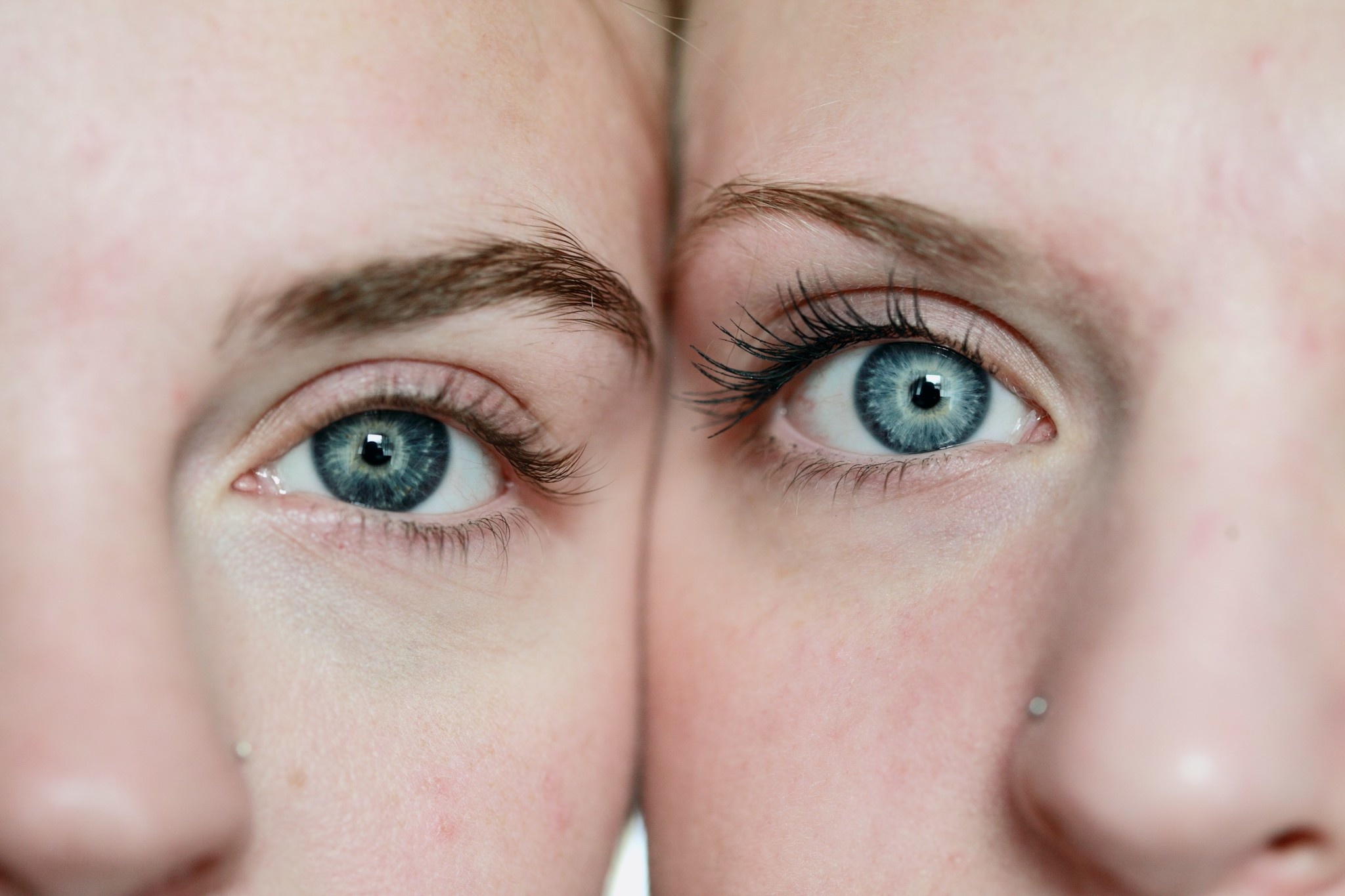 Waarom zonnebrandcrème helpt tegen acne