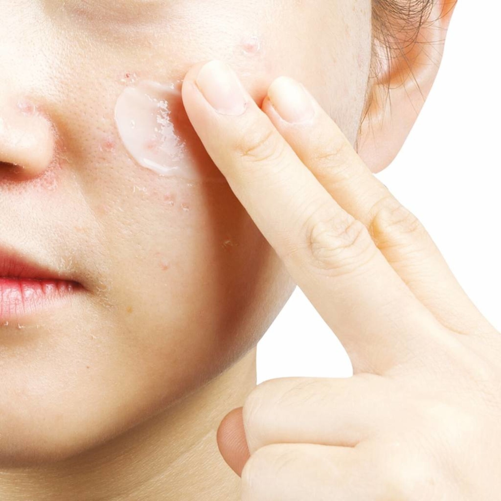 Yadah Anti-T Moisturizing Cream