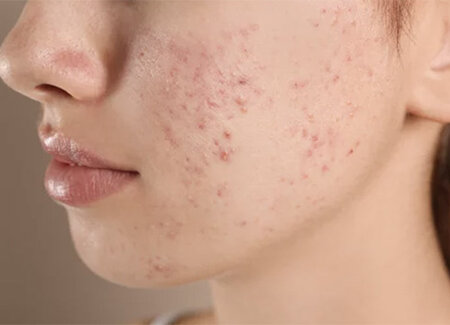 Acne Acne