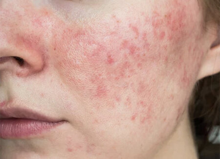 Rosacea / Hives Rosacea / Hives