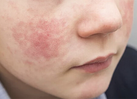 Eczema Eczema