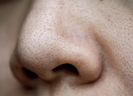 Blackheads Blackheads