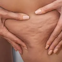 Cellulite?  Here's how to make it less visible