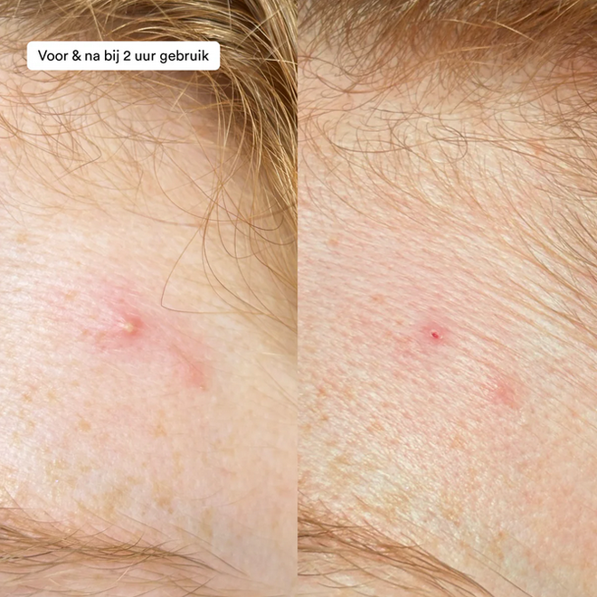 Ray - Acne Prone skin - Pimple paste (15ml)