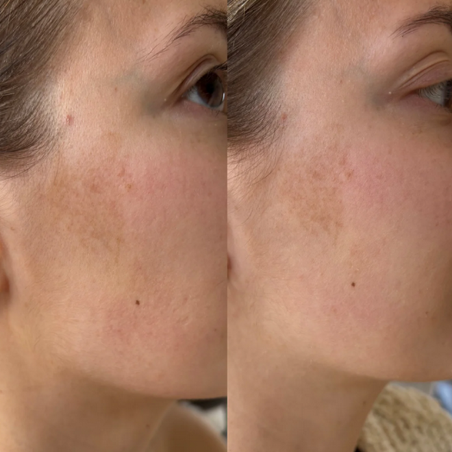 Ray - Anti Aging - Anti pigment vlekken serum