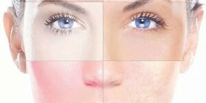 Wat is het verschil tussen huidtypes en huidcondities?