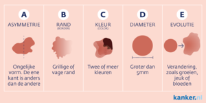 Hoe herken je een melanoom?