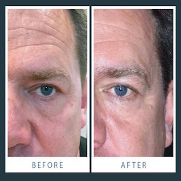 Wrinkle Schminkles Eye Smooting Kit for men - anti-rimpelpads voor de ogen voor mannen