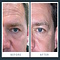 Wrinkle Schminkles Eye Smooting Kit for men - anti-rimpelpads voor de ogen voor mannen