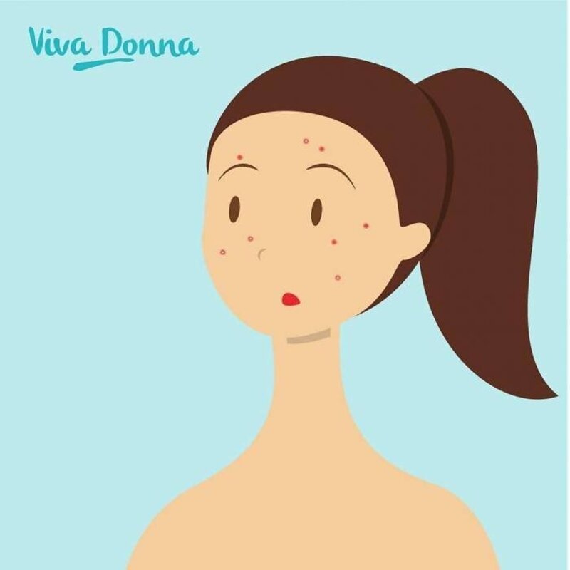 Ojee, Rond je 30e nog acne.