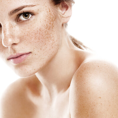 Zo voorkom je pigmentvlekken