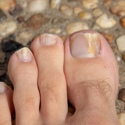 Dé tip tegen kalknagels