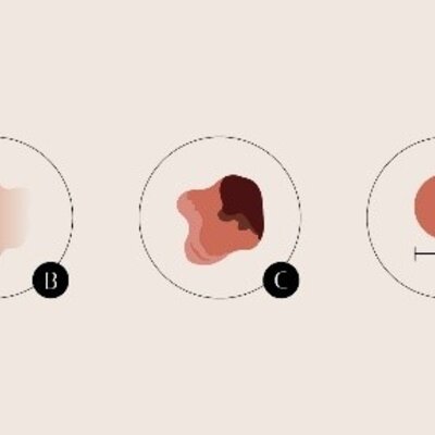 Check je huid op verdachte plekjes